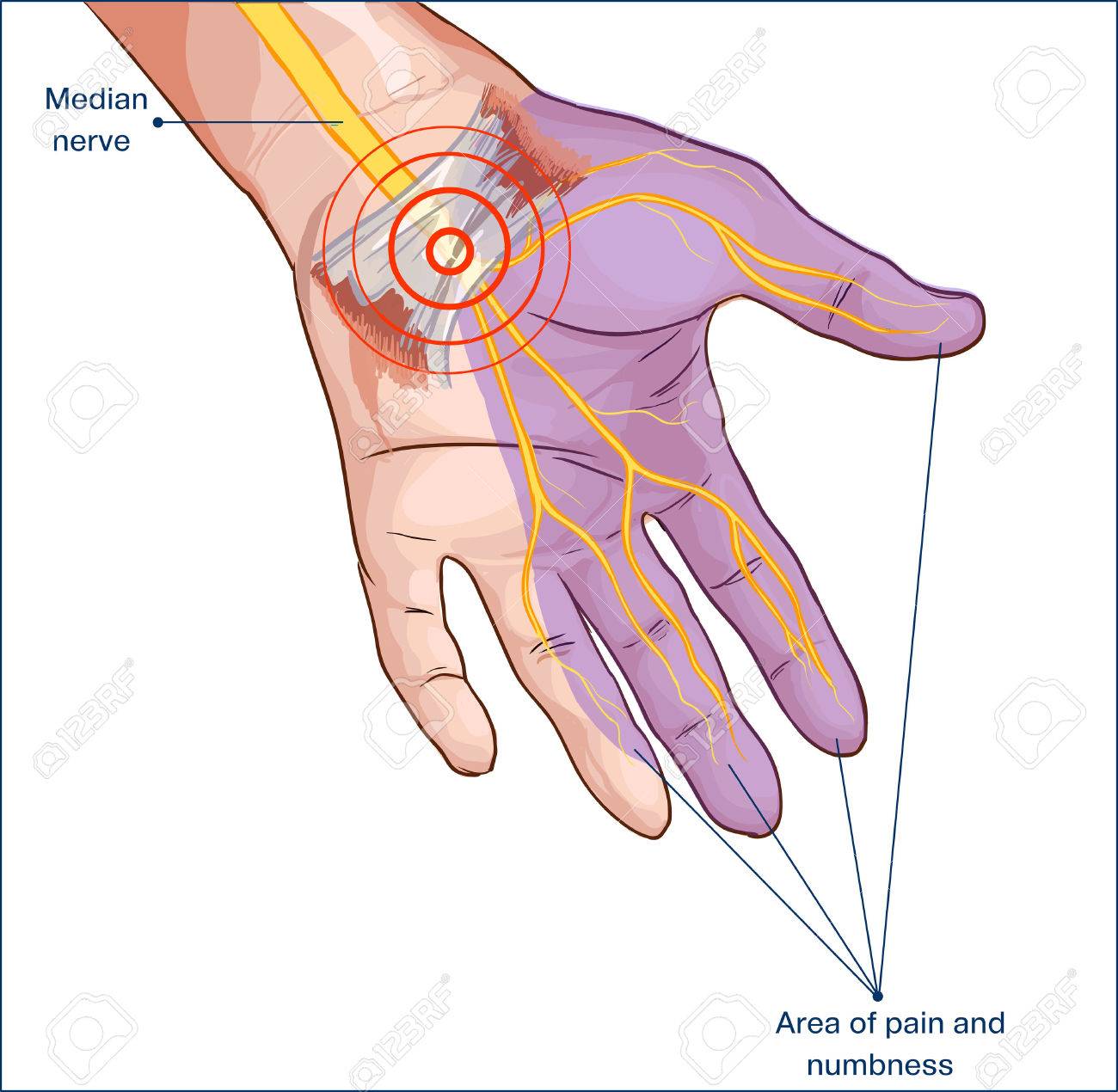 transverse carpal ligament compressed median nerve hand - 73199850 transverse carpal ligament compressed median nerve hand - 73199850