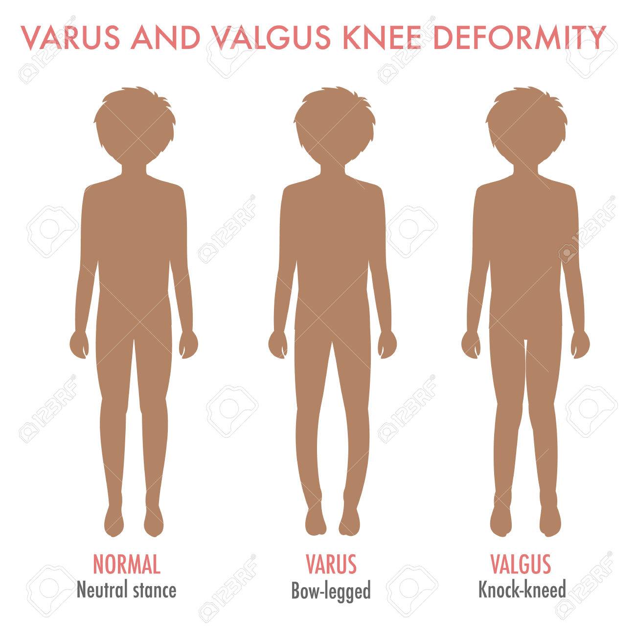Valgus, varus knee, legs disease, deformation infographic. Boy silhouette with normal leg