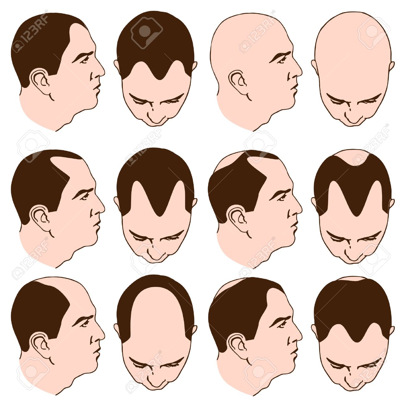 An Image Of Man With Various Receding Hairlines Royalty Free