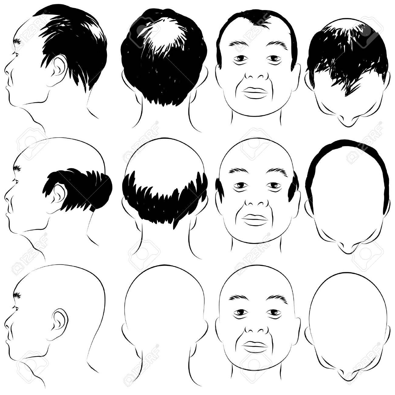 What Is Male Pattern Baldness Magnificent Design What Is Male Pattern Baldness Magnificent Design