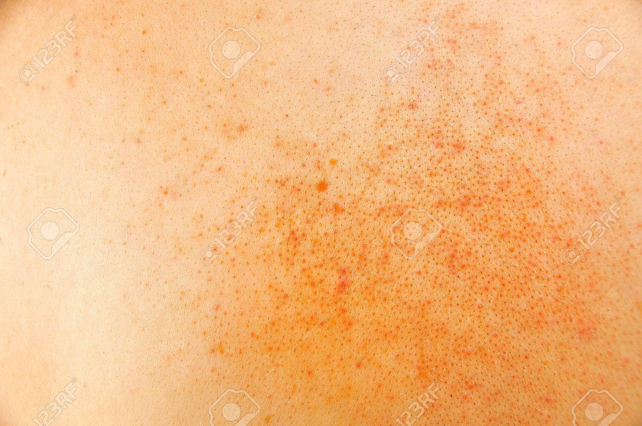 primer plano de la piel enferma de la dermatitis atópica fotos