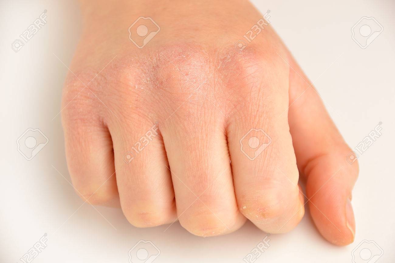 very dry skin on hands