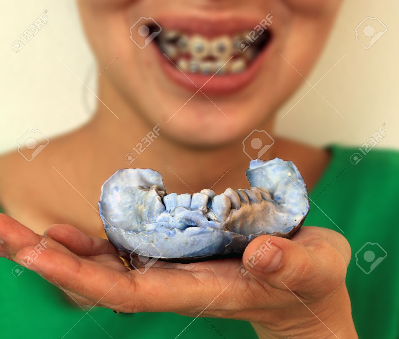 dental arch plaster mold and brace stock photo picture and royalty dental arch