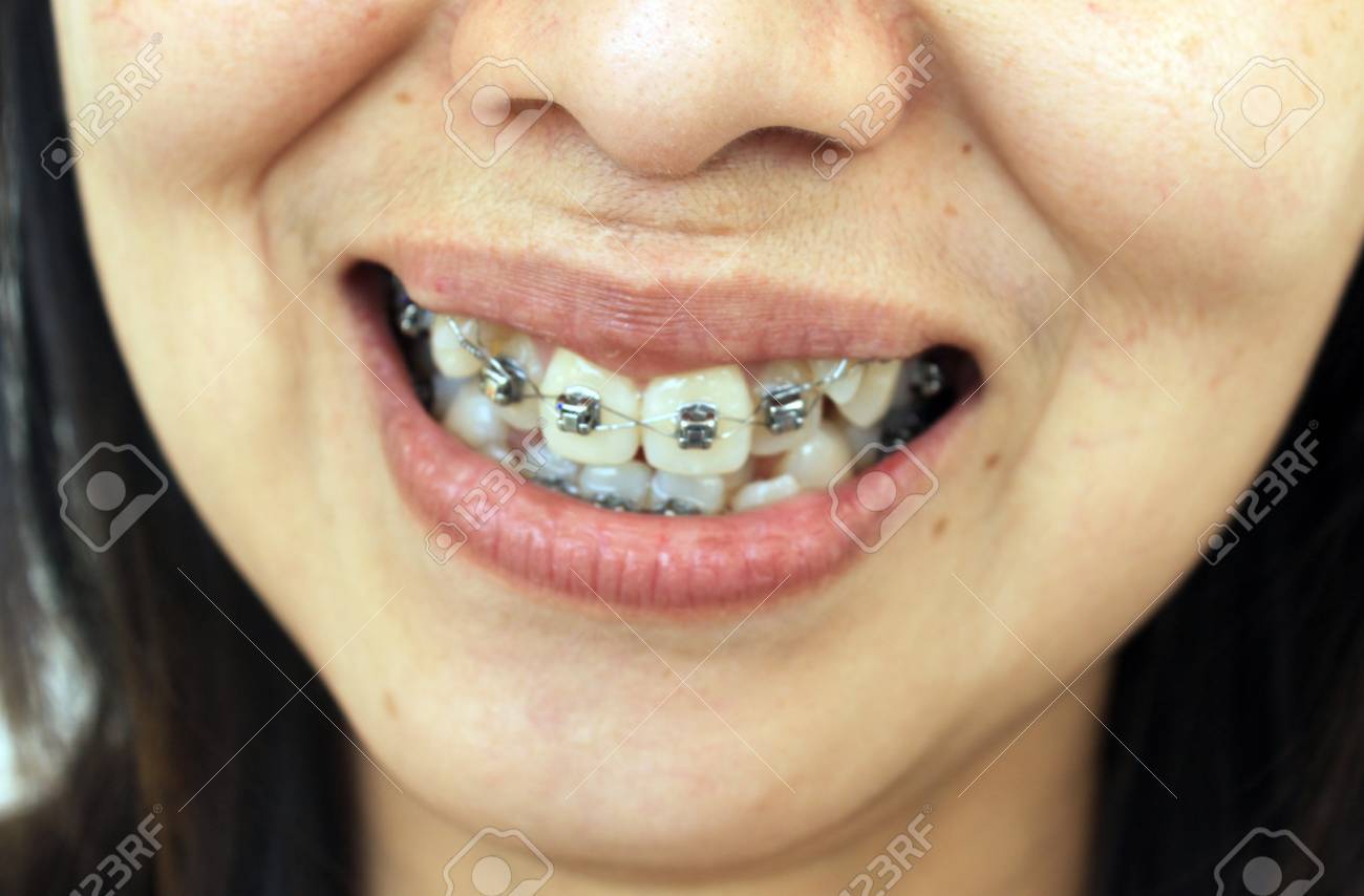 歯のためのダイヤモンド ブレース の写真素材 画像素材 Image