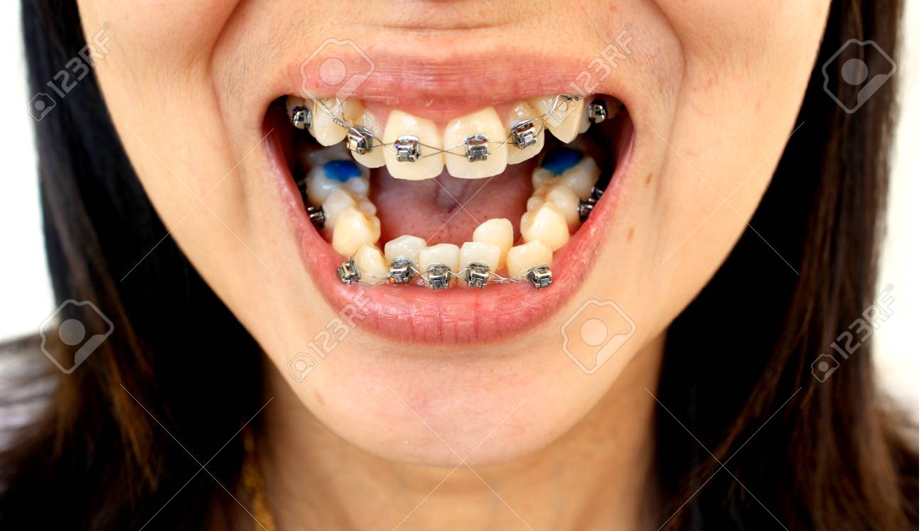 歯のためのダイヤモンド ブレース の写真素材 画像素材 Image
