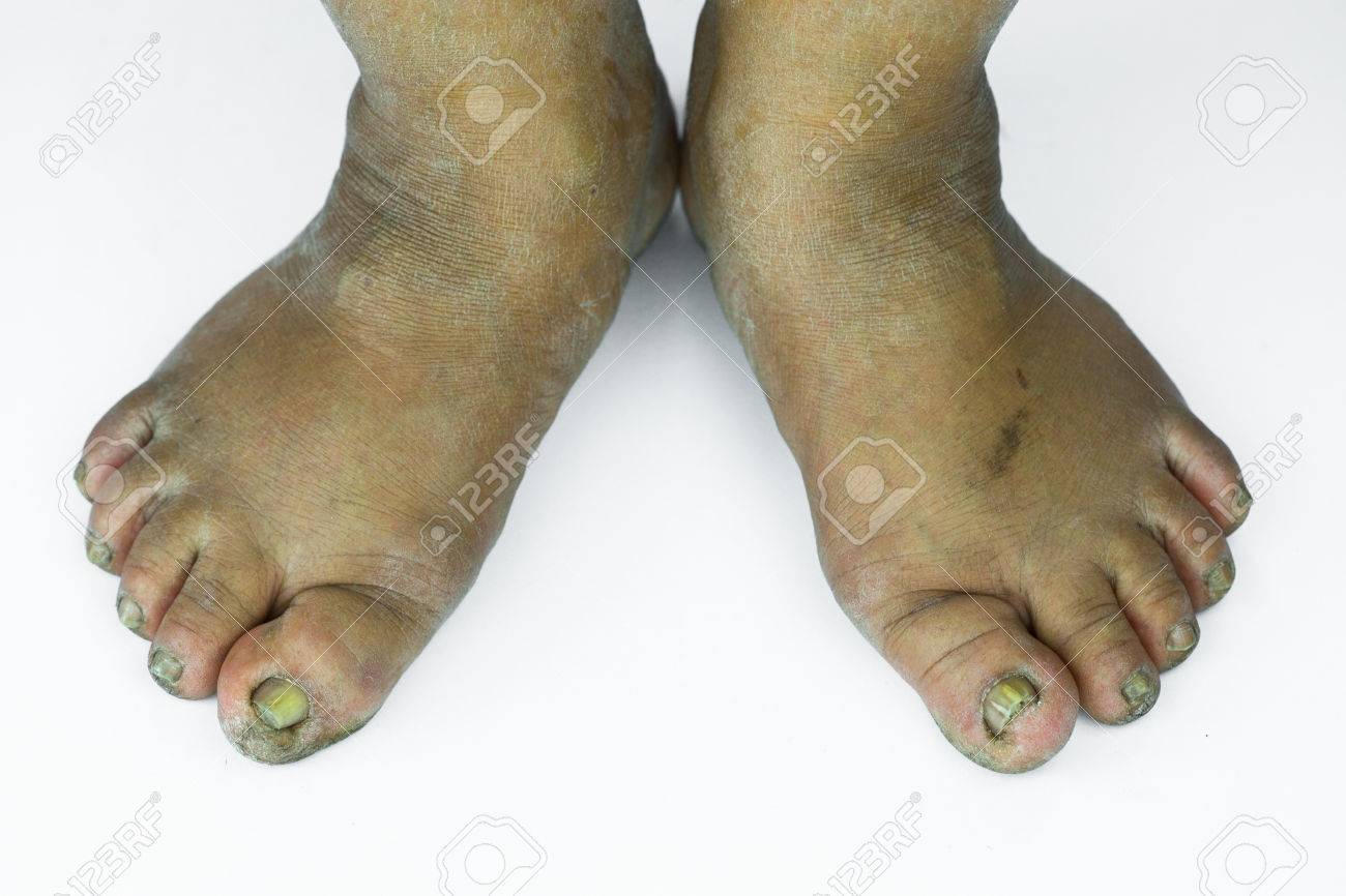 Dirty Foot Ored Heels Isolate On White Background Medical Or Feet Health Of The Dirty Foot Ored Heels Isolate On White Background Medical Or Feet Health Of The
