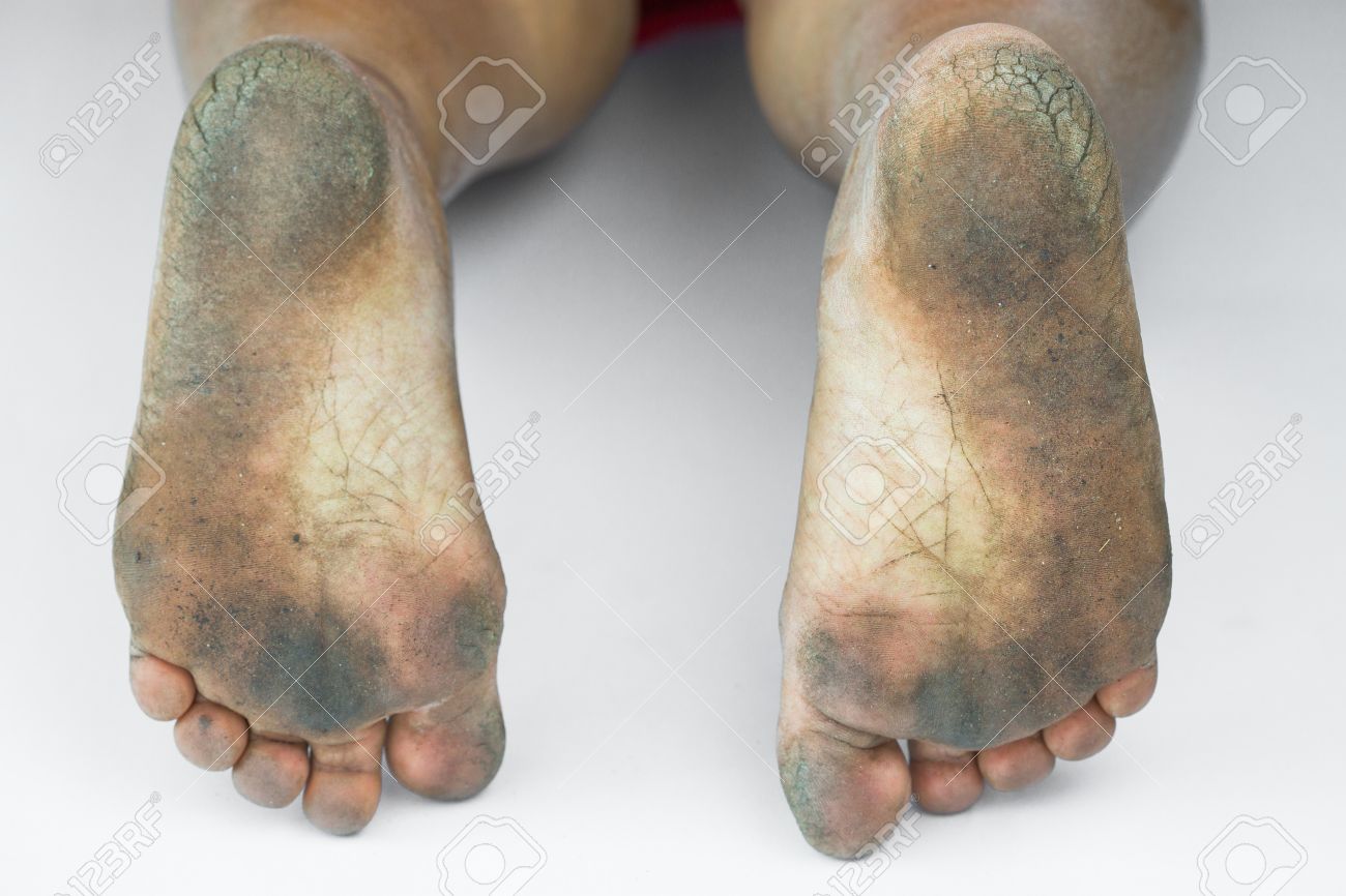 Dirty Foot Ored Heels Isolate On White Background Medical Or Feet Health Of The Dirty Foot Ored Heels Isolate On White Background Medical Or Feet Health Of The