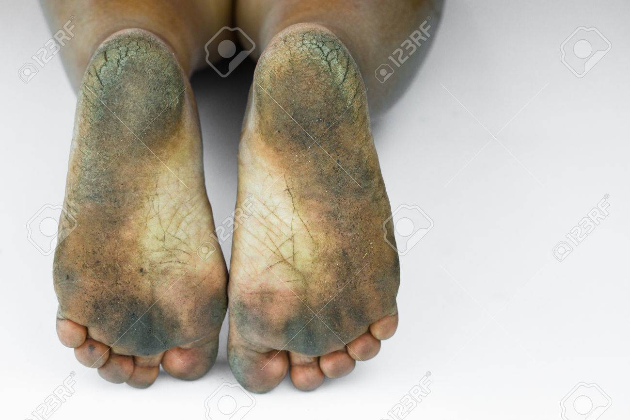 Dirty Foot Ored Heels Isolate On White Background Medical Or Feet Health Of The Dirty Foot Ored Heels Isolate On White Background Medical Or Feet Health Of The