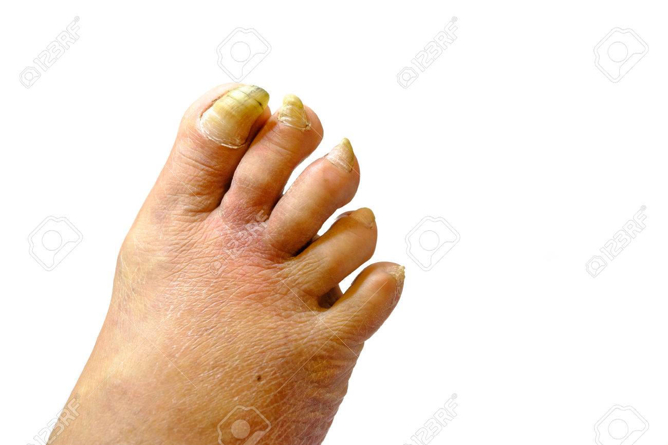 Sick unhealthy nails on the foot of a man isolated - 74705118 Sick unhealthy nails on the foot of a man isolated - 74705118