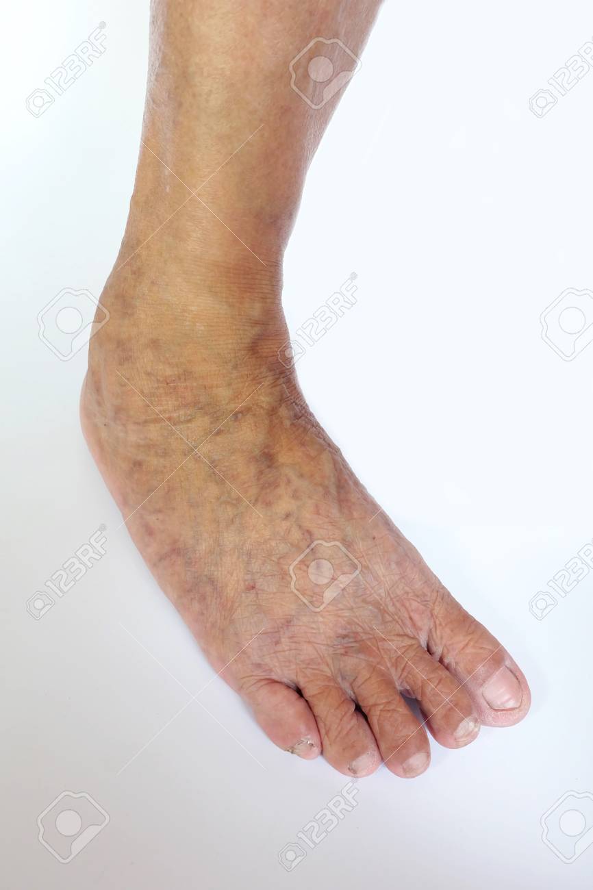 varicose foot pictures fotografie