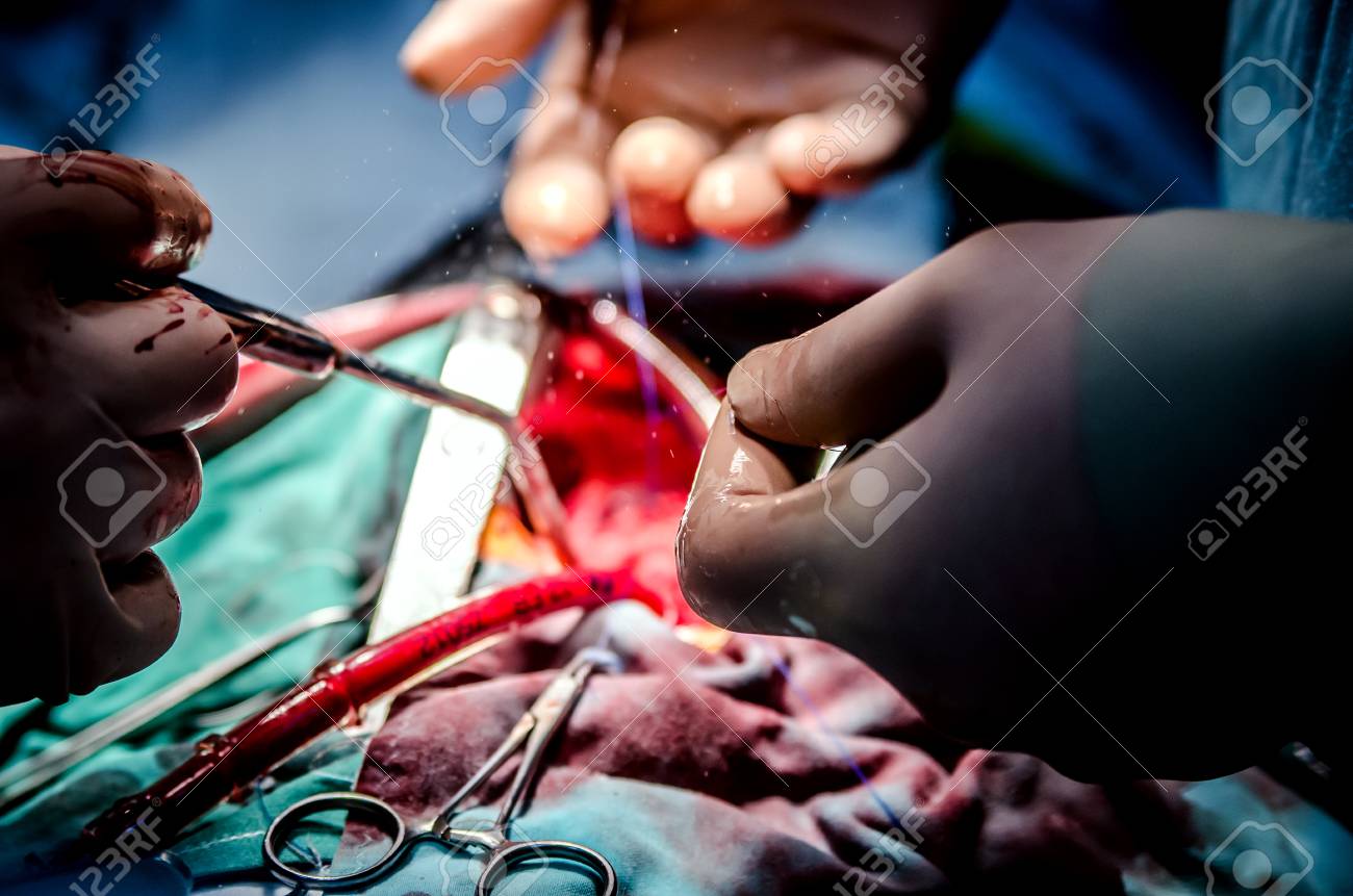 心臓手術のプロセスです 焦点は 医療にクランプし 執刀医の腕で吸引します カットは背景に表示されます の写真素材 画像素材 Image