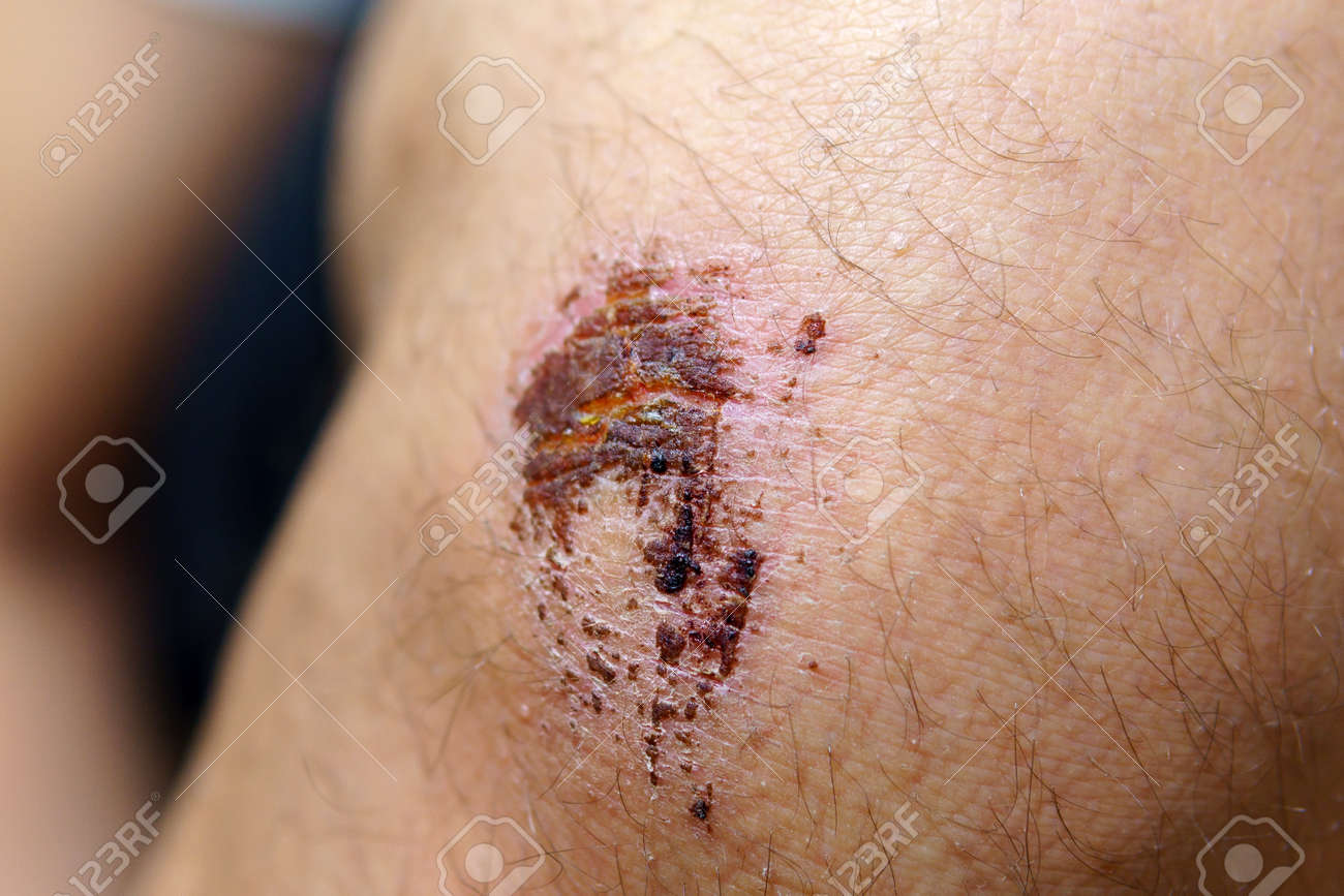 skin of the knee caused by an accident. Close-up of knee bruised wounded. selective focus - 167897168 skin of the knee caused by an accident. Close-up of knee bruised wounded. selective focus - 167897168