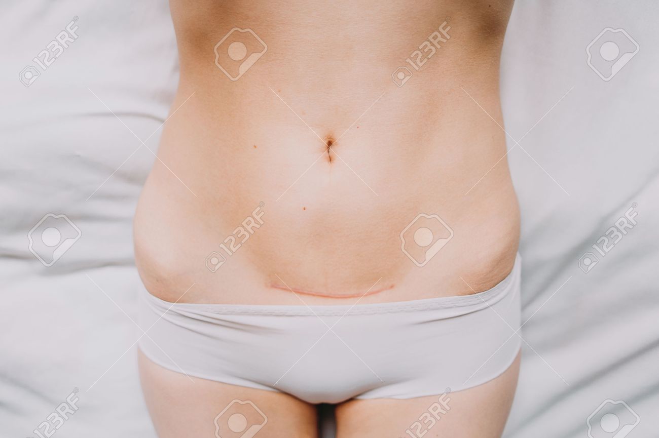 女性の腹から帝王切開で傷跡のクローズ アップ の写真素材 画像素材 Image