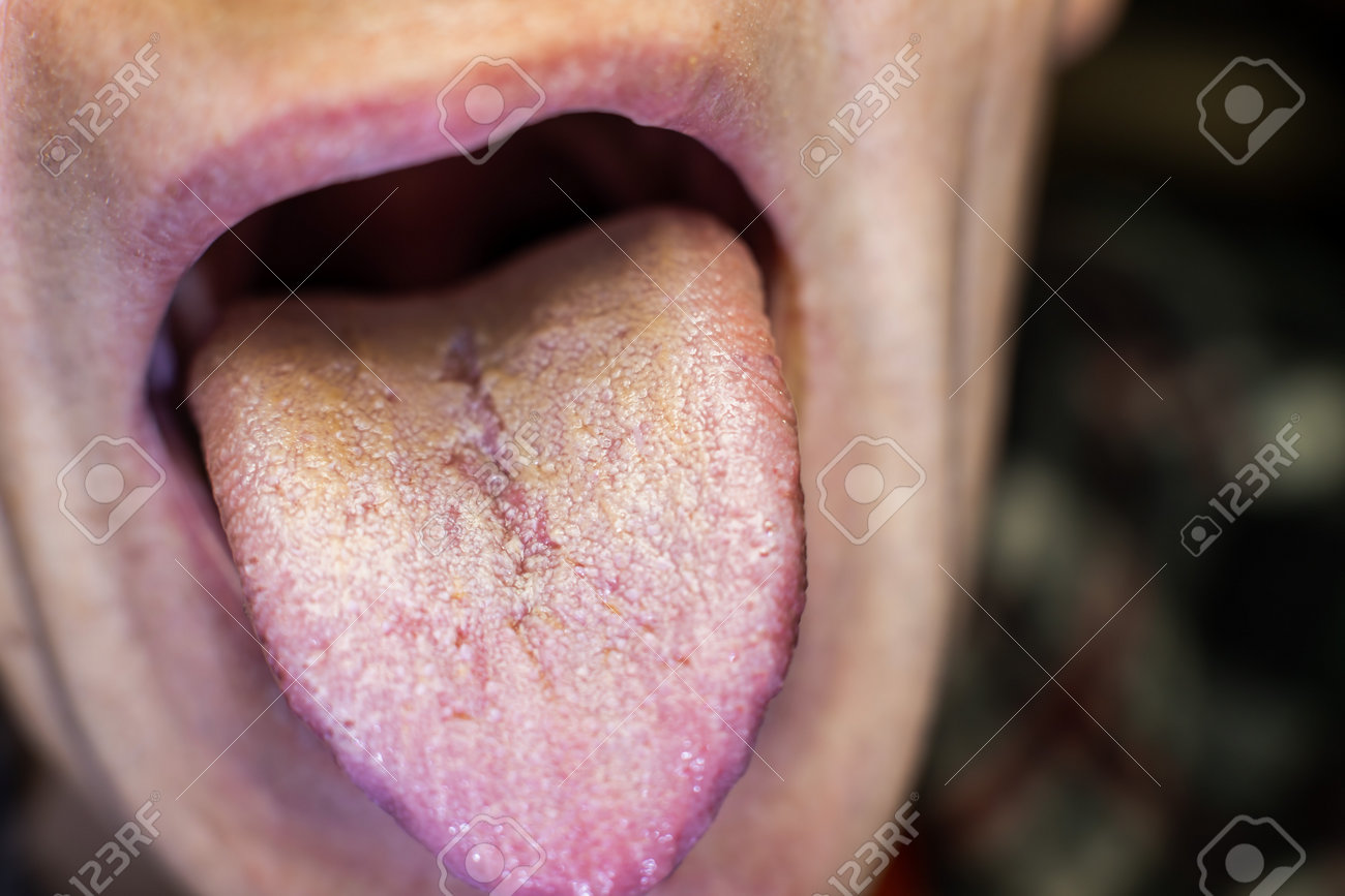 Oral Thrush Symptoms, Causes, Treatment \u0026 Prevention | Jefferson Dental \u0026  Orthodontics, image size:1300x867