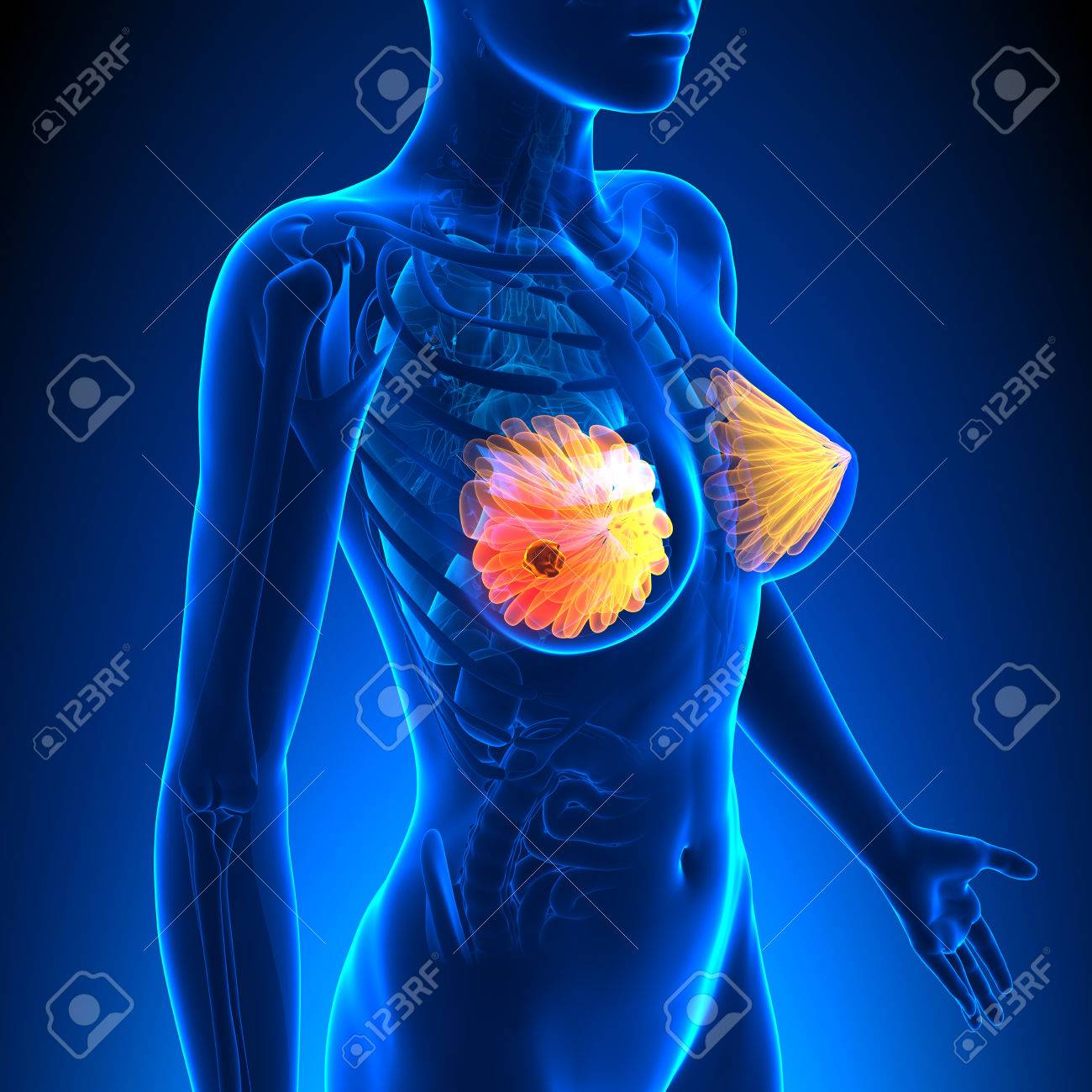 Breast Cancer Female Anatomy Tumor Highlight Stock Photo Picture And Royalty Free Image Image 35357614