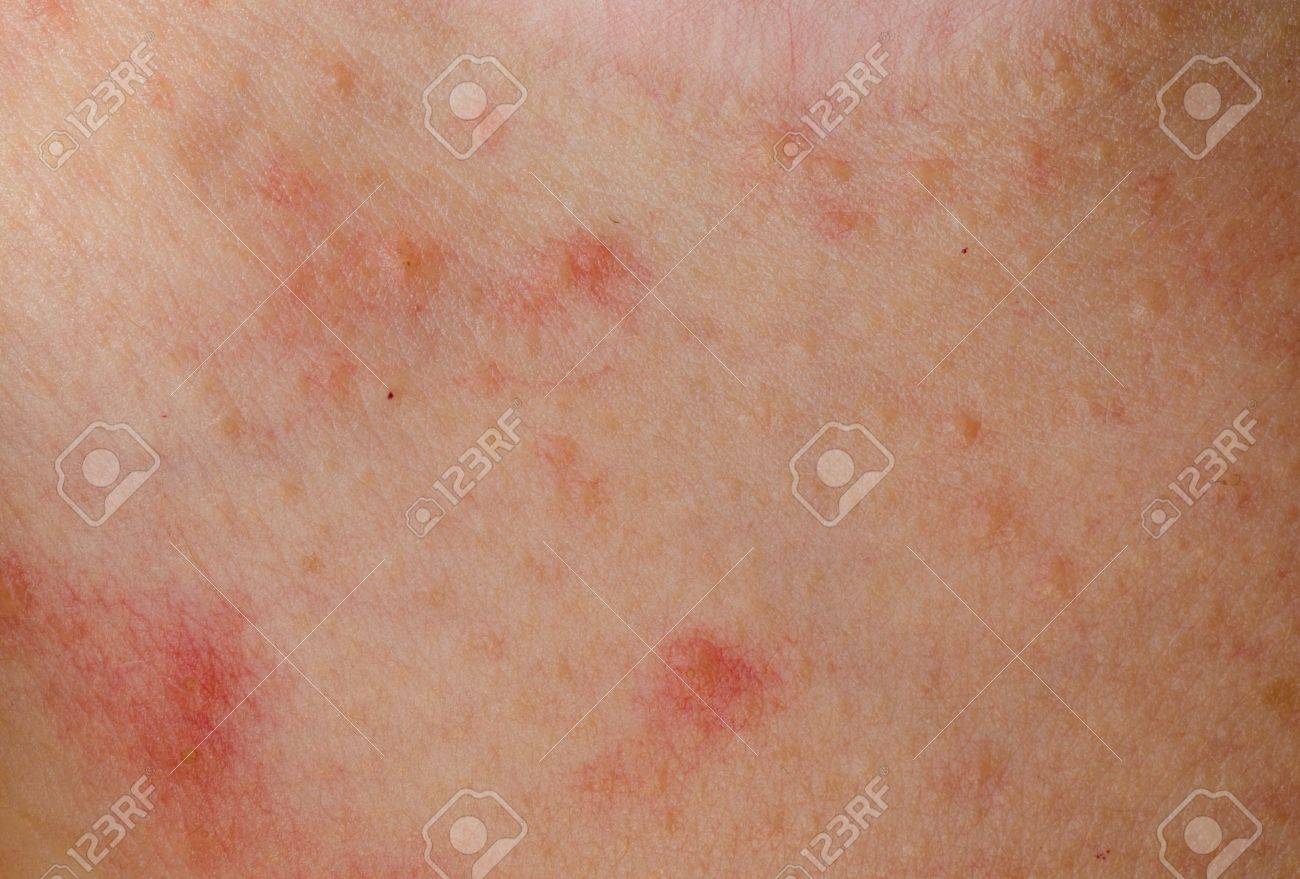 enfermo erupción eczema dermatitis alérgica de la piel del paciente