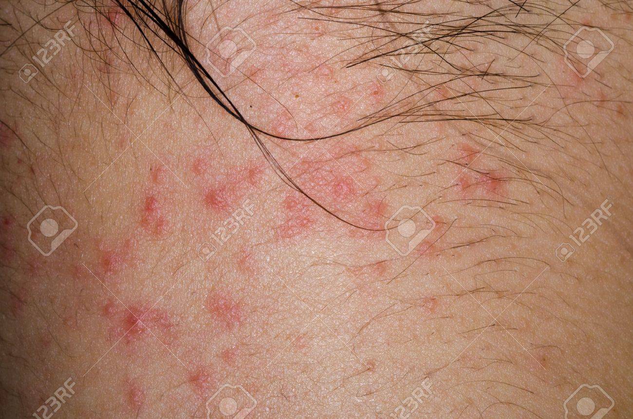 enfermo erupción eczema dermatitis alérgica de la piel del paciente