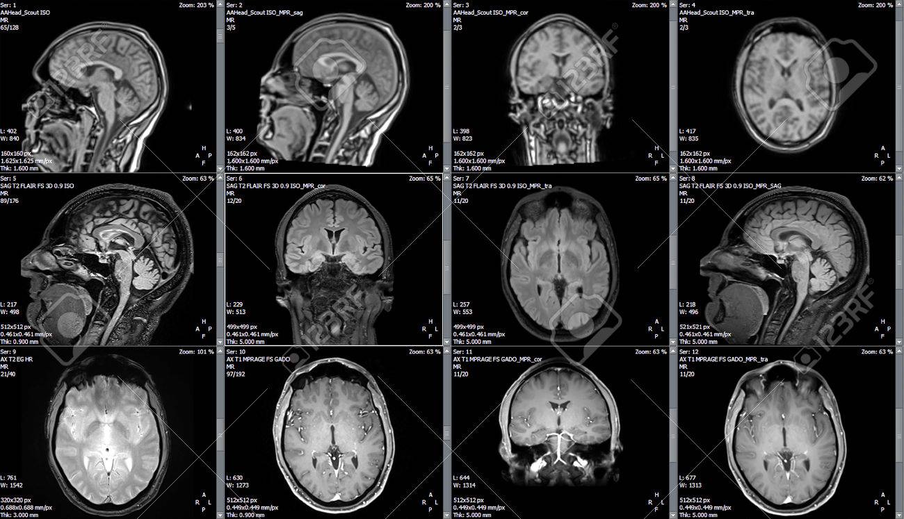 examen resonancia nuclear magnetica cerebral