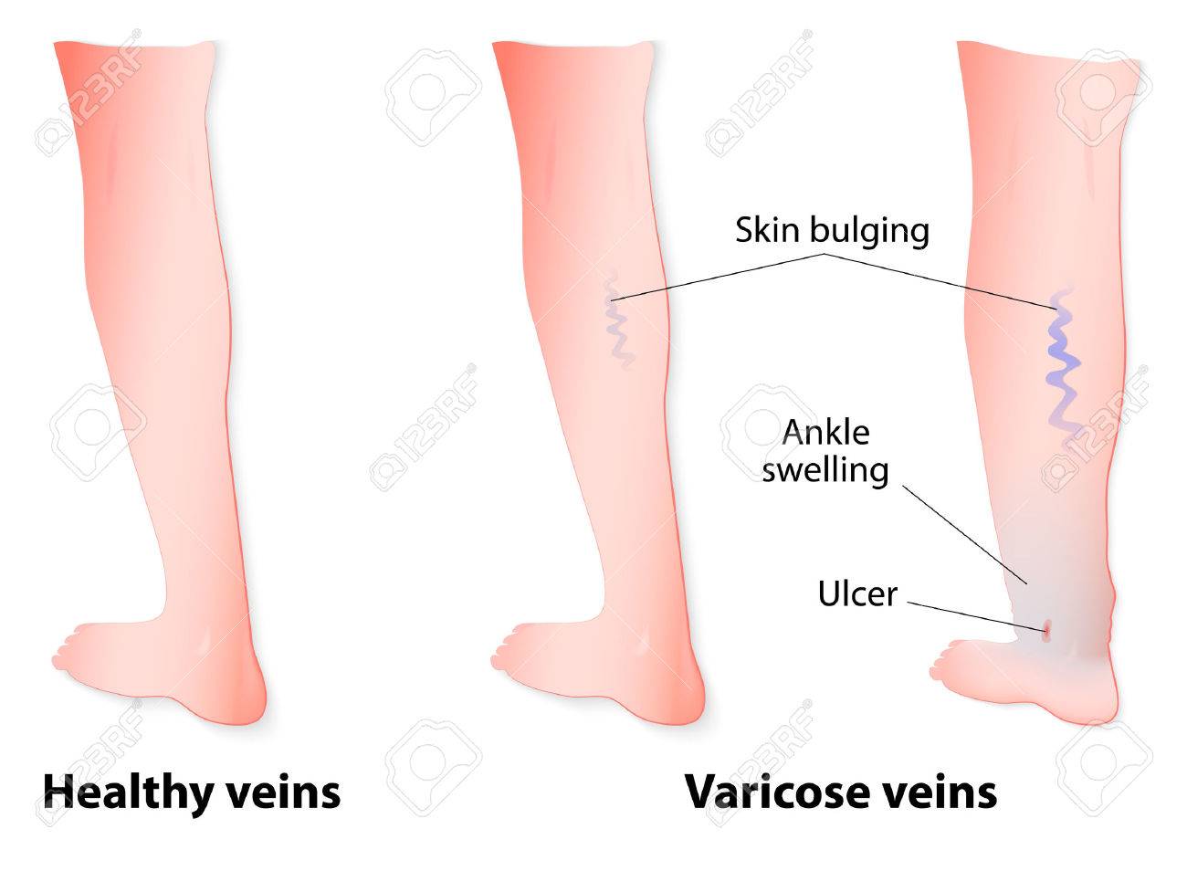 venas varicosas que causan decoloración