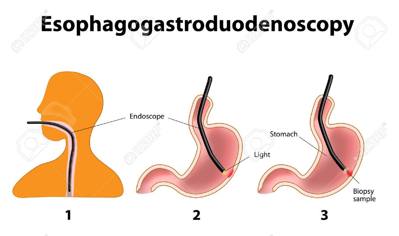que se ve en una endoscopia digestiva alta que se ve en una endoscopia digestiva alta