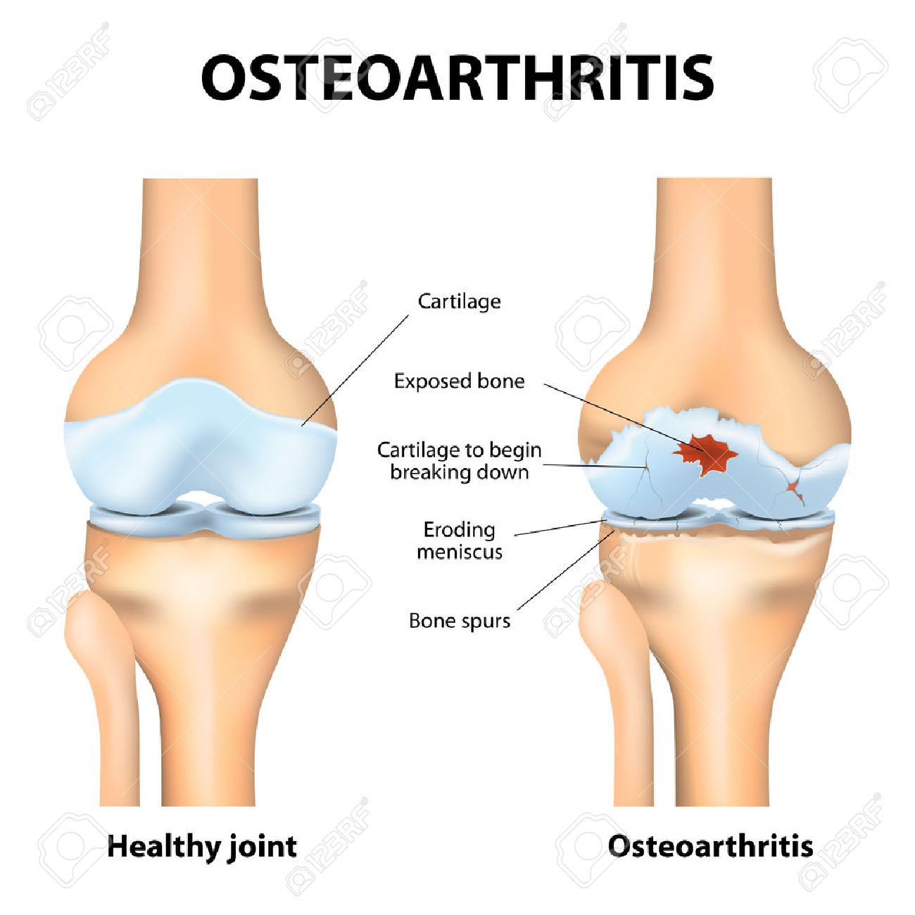 Osteoarthritis. Arthritis or pain within a joint. degenerative joint disease. Cartilage becomes worn. This results in inflammation, swelling, and pain in the joint. - 32059610 Osteoarthritis. Arthritis or pain within a joint. degenerative joint disease. Cartilage becomes worn. This results in inflammation, swelling, and pain in the joint. - 32059610
