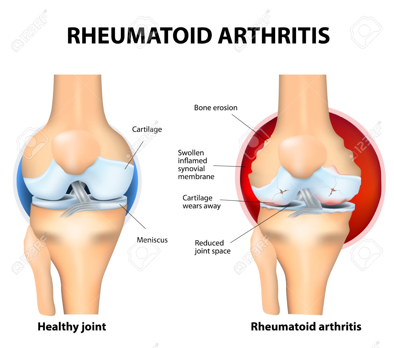 que es una reuma linear unit solfa syllable rodilla