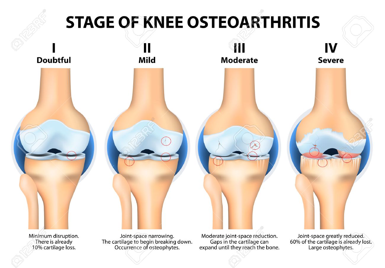 Osteoarthritis knee kellgren lawrence, Hogyan kezeljük a lábízületi gyulladást tablettákkal