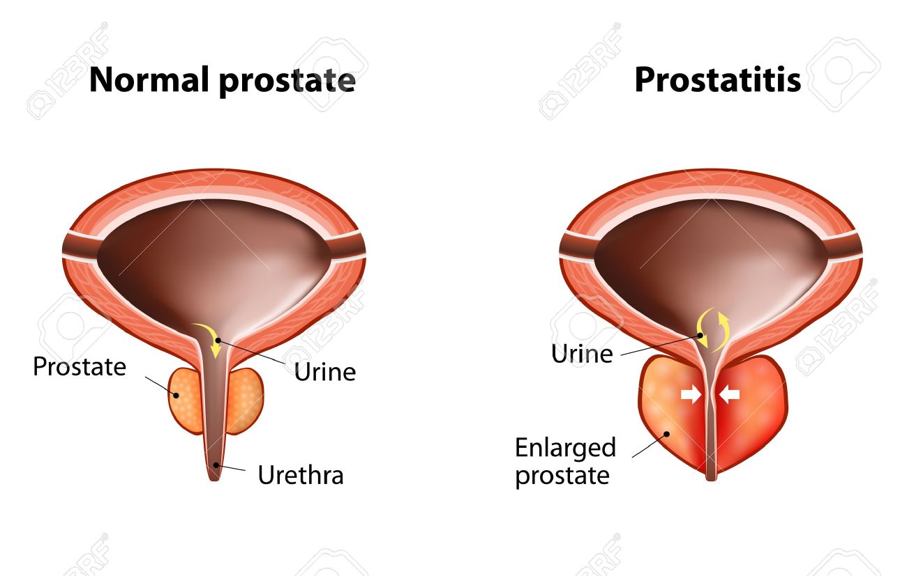 prostatitis kezelés a legjobb)