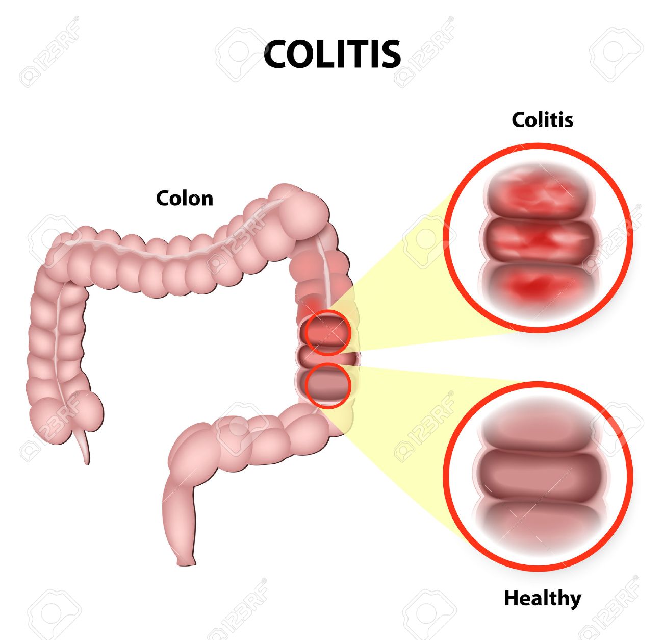Ulcerative Colitis Is A Chronic Disease That Results In Inflammation Of The Colon S Innermost Layer Royalty Free Cliparts Vectors And Stock Illustration Image