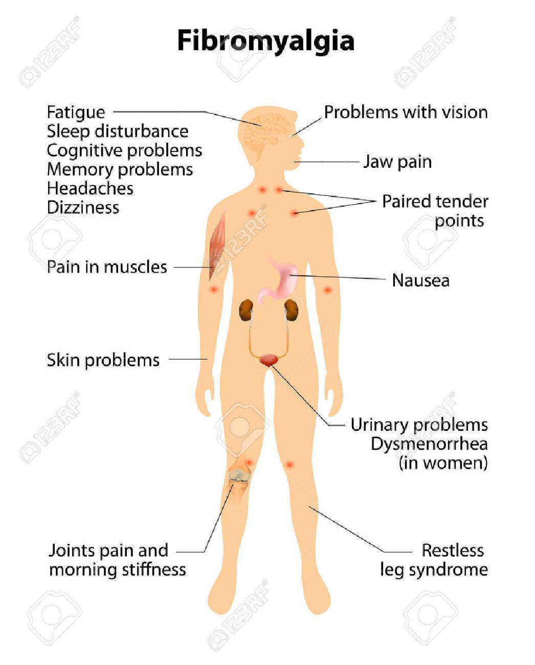 De signos fibromialgia sintomas y
