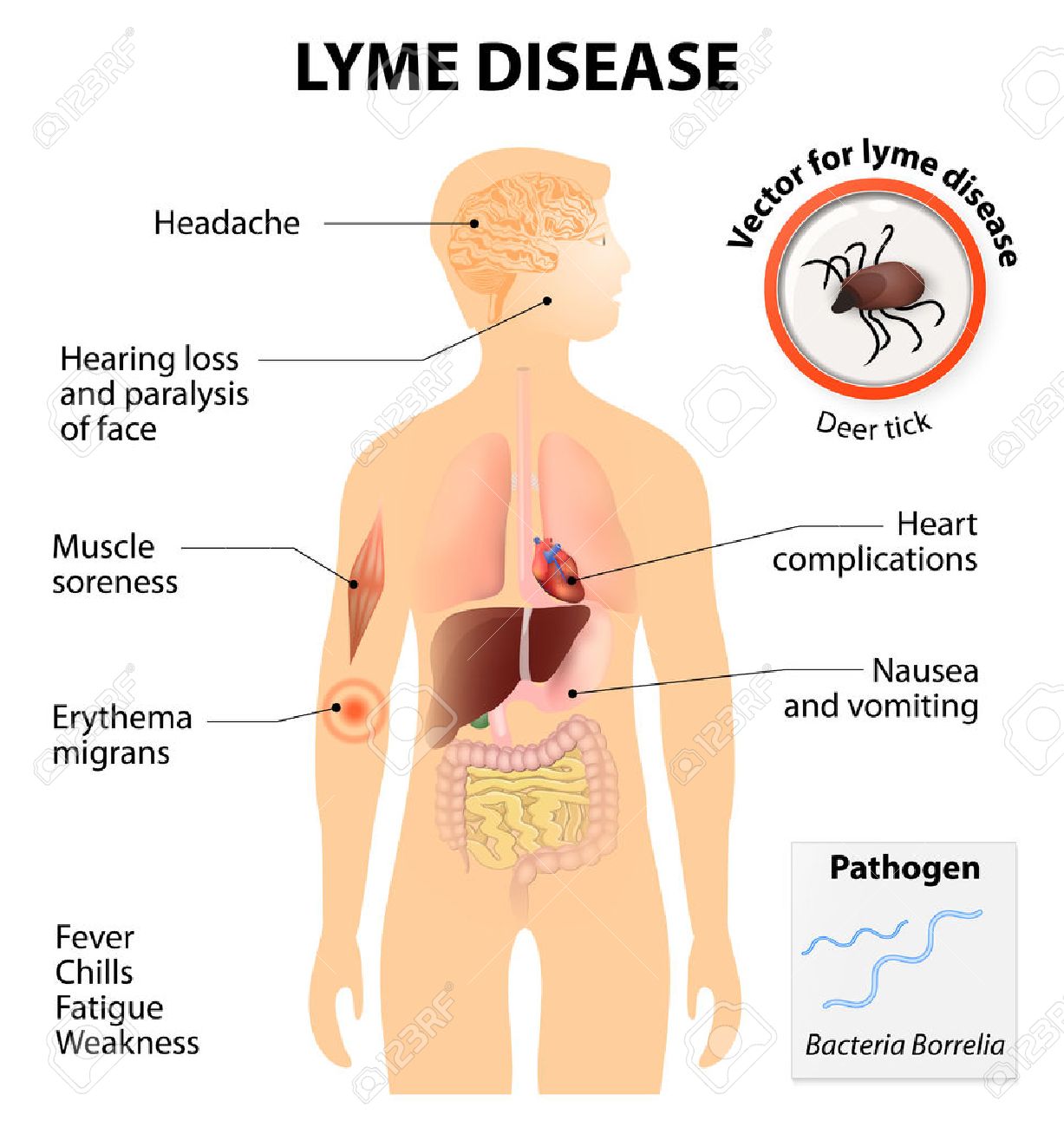 Watch Lyme Disease Symptoms and Complications video Watch Lyme Disease Symptoms and Complications video
