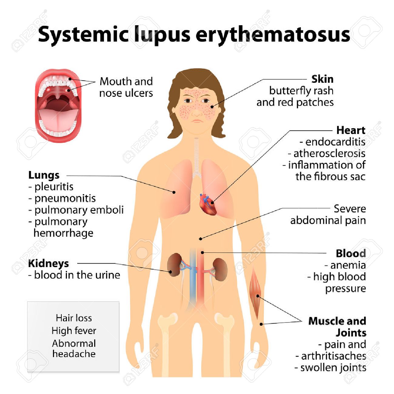 whats systemic lupus erytematosus essay whats systemic lupus erytematosus essay