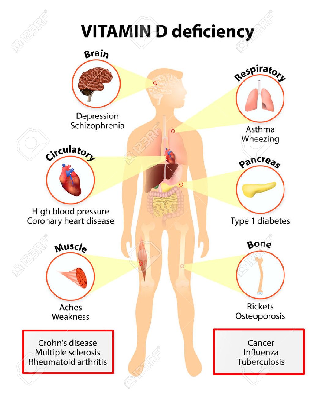 Vitamin D Deficiency Symptoms And Diseases Caused By Insufficient