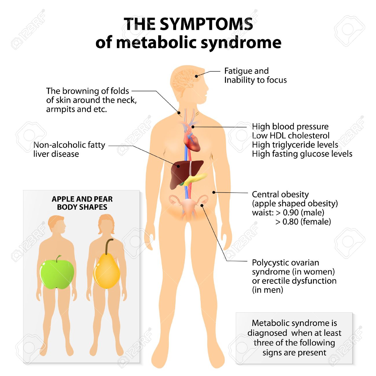 síndrome metabólico resistente a la insulina y pre diabetes