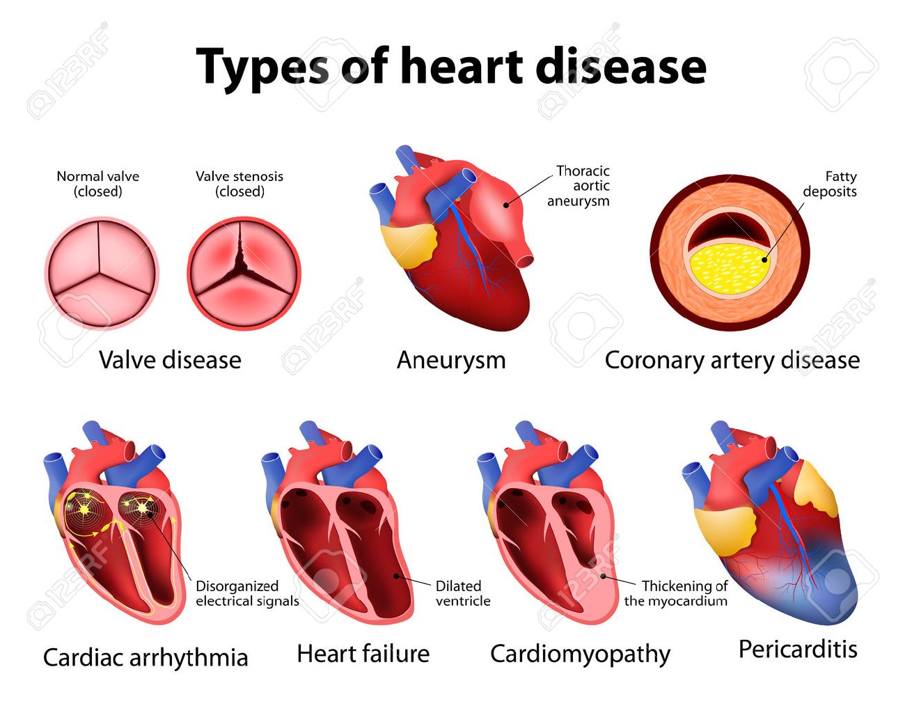 Types of diseases. Заболевания сердца на английском. Types of diseases. Types of diseases. Расшифровка glycogen storage disorder.