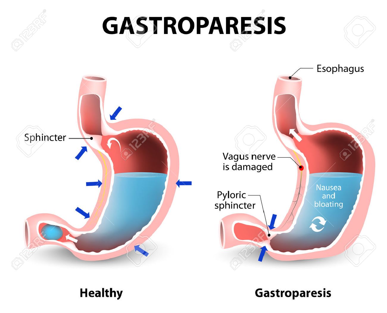 Gastroparesis Or Delayed Gastric Emptying. Visual Comparison Of Healthy  Gastric And Stomach With Gastroparesis. Royalty Free SVG, Cliparts,  Vectors, and Stock Illustration. Image 54511475.