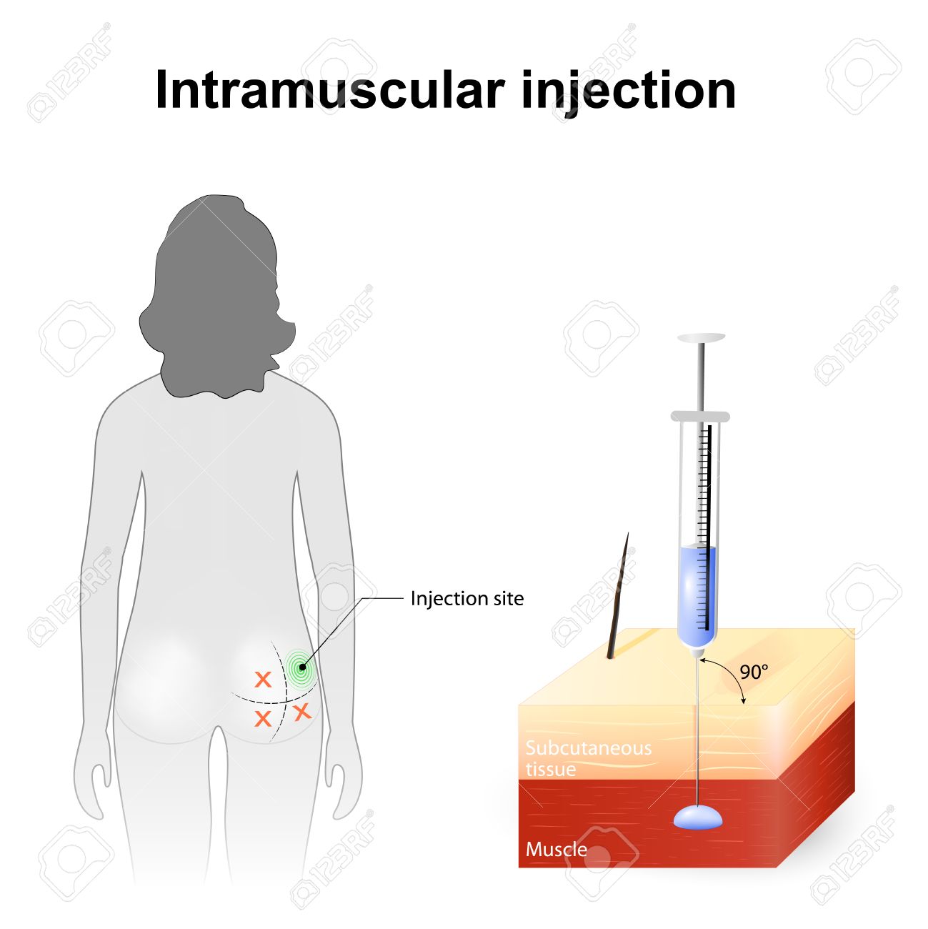 intramuscular injection sites