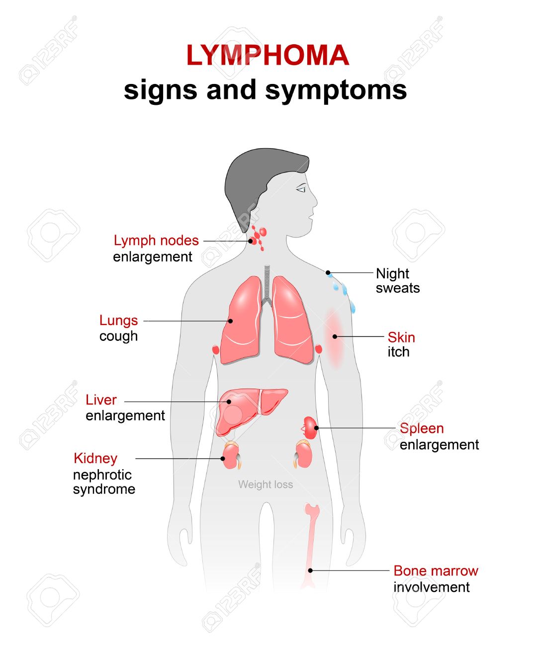 lymphoma cancer disease signs and symptoms man silhouette