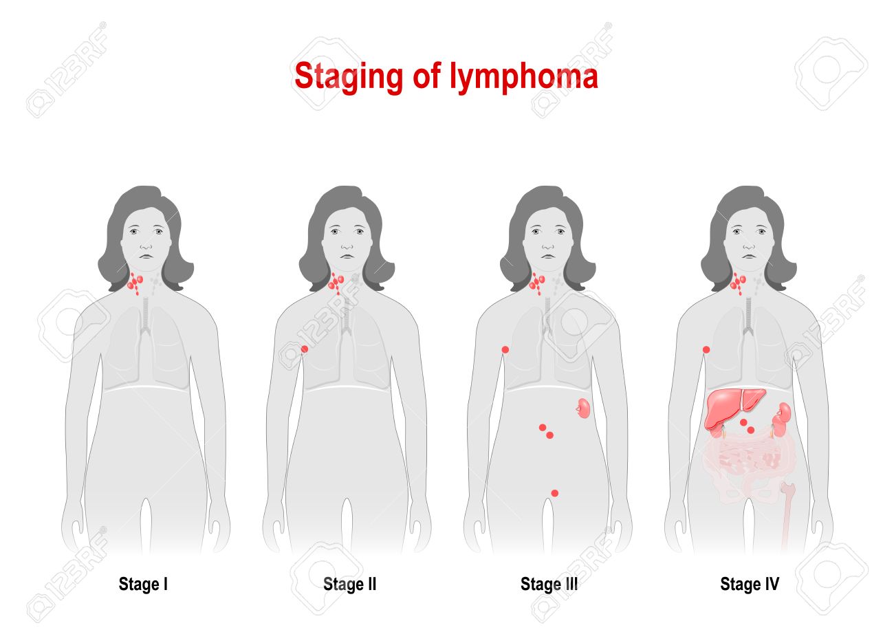 staging of lymphoma cancer of the lymphatic system signs and