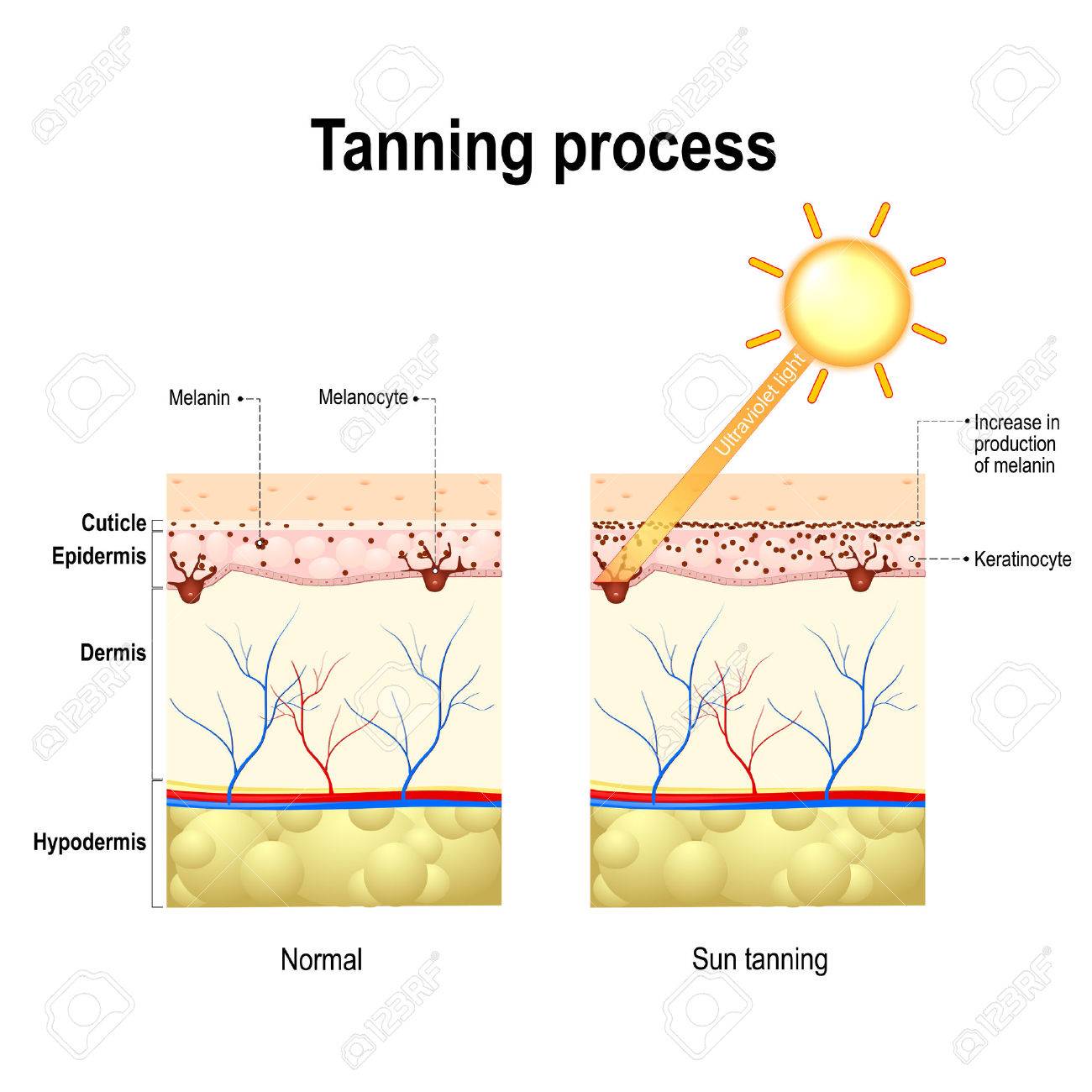 Tanning process. When ultraviolet light waves touch melanocytes, they begin to increase the production of melanin. The skin becomes dark color - 68919400 Tanning process. When ultraviolet light waves touch melanocytes, they begin to increase the production of melanin. The skin becomes dark color - 68919400