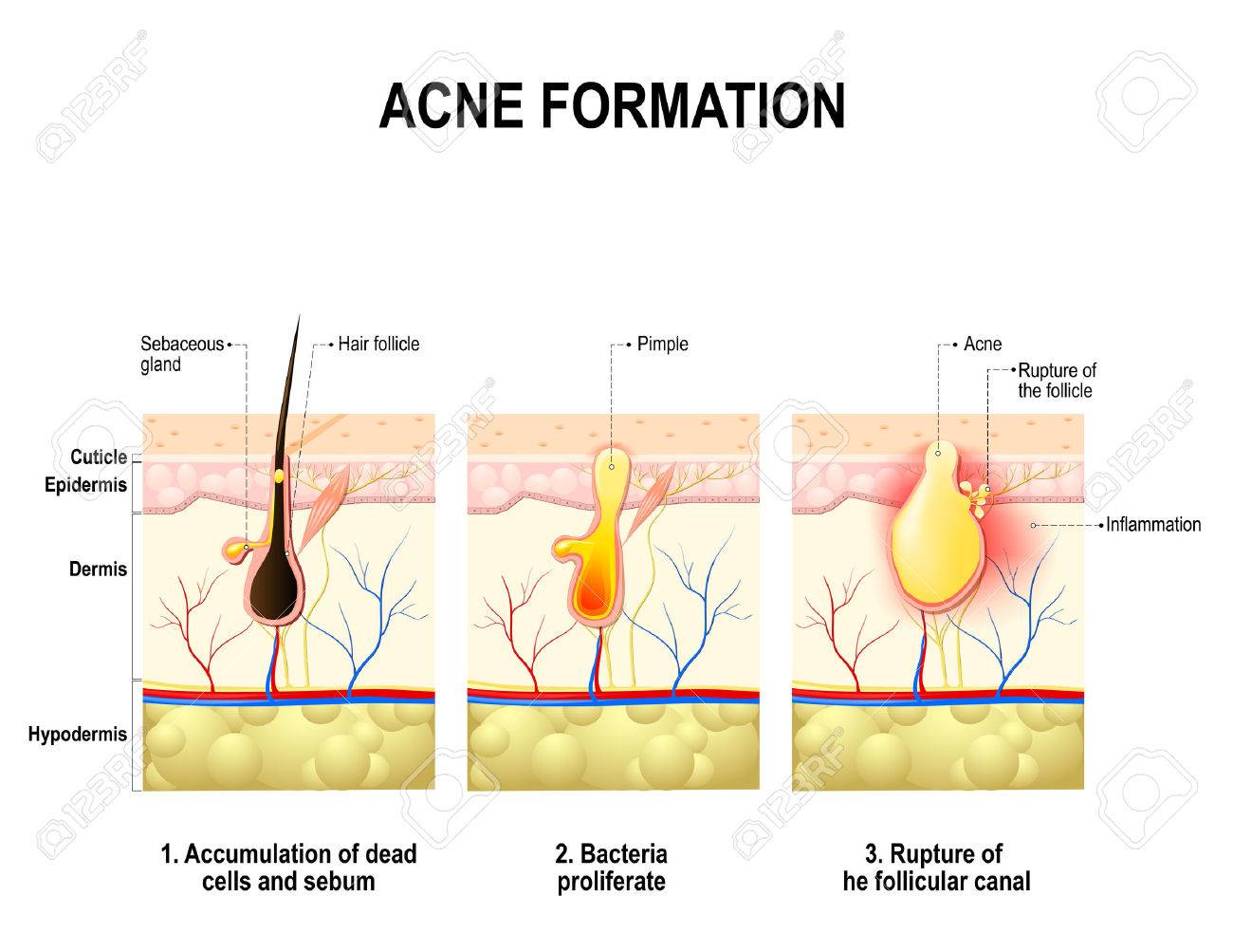 人間の皮膚ににきびの形成の 3 つの段階 詰まった毛穴の皮脂は 細菌のプロピオン酸のにきびの成長を促進します これは 赤みや炎症 にきびに関連付けられていることに します 診療所 学校などののイラスト素材 ベクタ Image