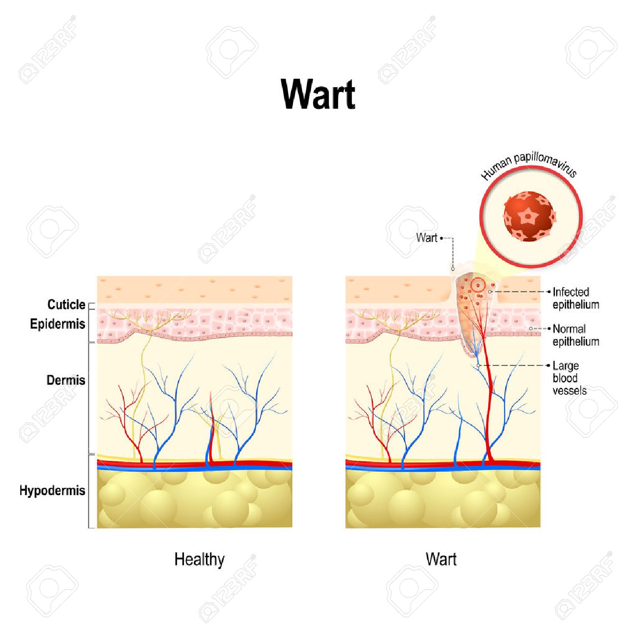 human papillomavirus warzen)