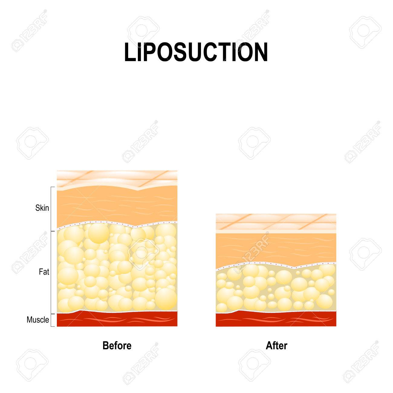 Como sacar la grasa del cuerpo