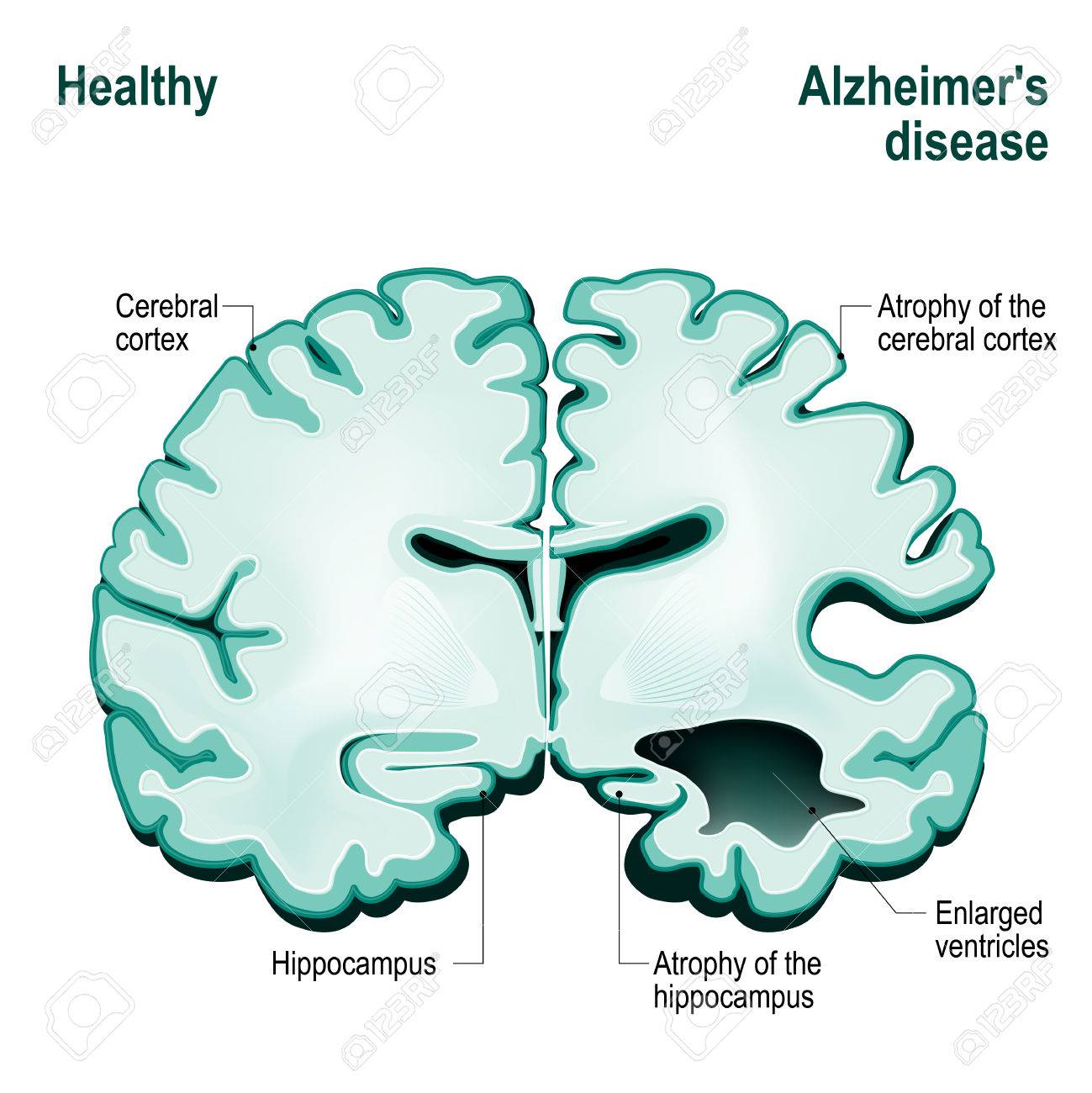 人間の脳の断面図 アルツハイマー病 認知症 老化 と比較して健康的な脳 のイラスト素材 ベクタ Image