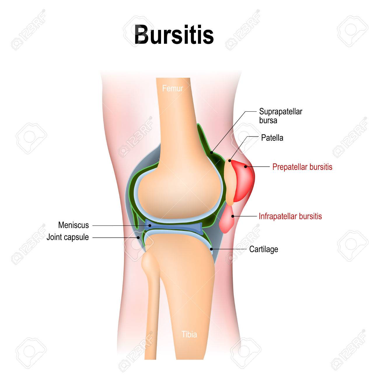 q es una bursitis de rodilla