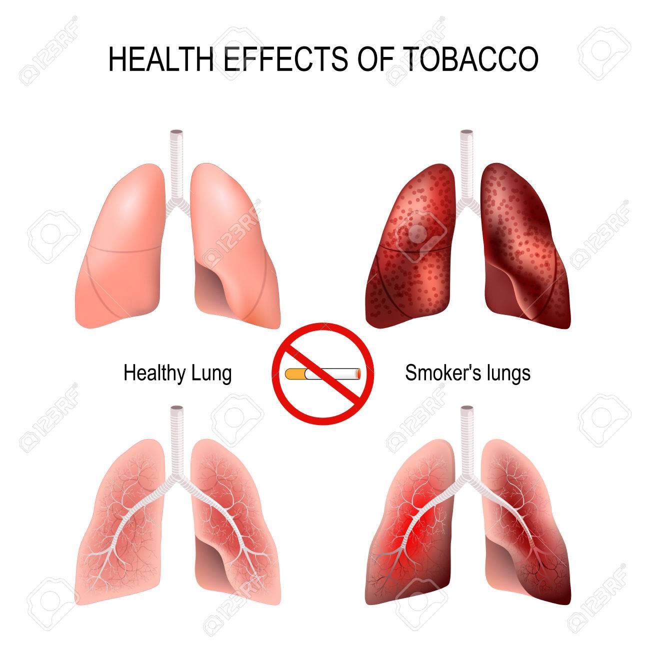 effects of smoking on the lungs