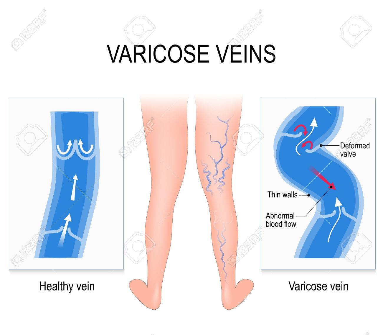 ulei de brad din recenzii varicose recenzii