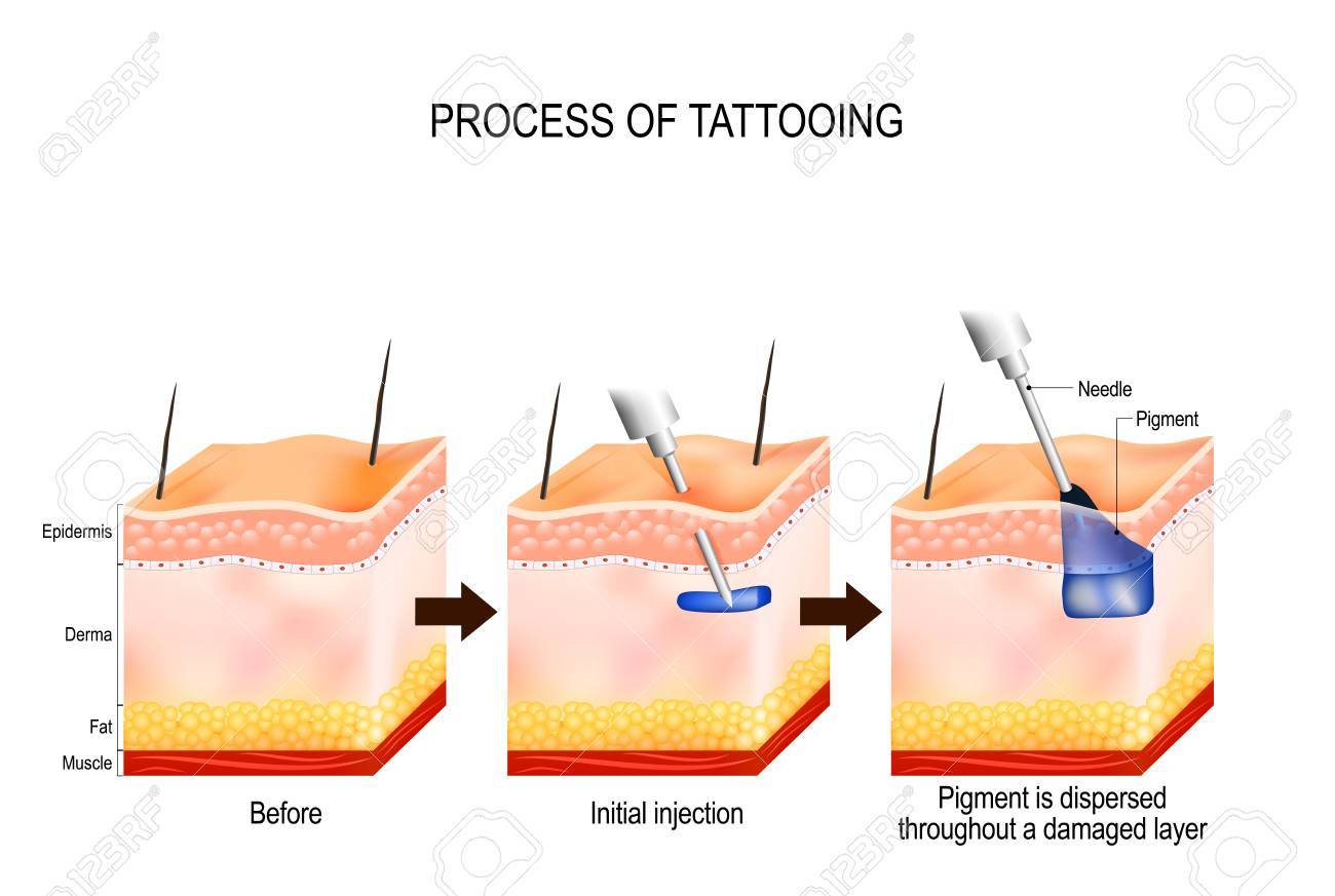 tattoo process. The tattooing process causes damage to the epidermis and dermis. Every time the needle penetrates, it causes a wound that alerts the body immune system. Pigment gets soaked up by skin cells and stay suspended in the dermis in perpetuity. - 88116217 tattoo process. The tattooing process causes damage to the epidermis and dermis. Every time the needle penetrates, it causes a wound that alerts the body immune system. Pigment gets soaked up by skin cells and stay suspended in the dermis in perpetuity. - 88116217