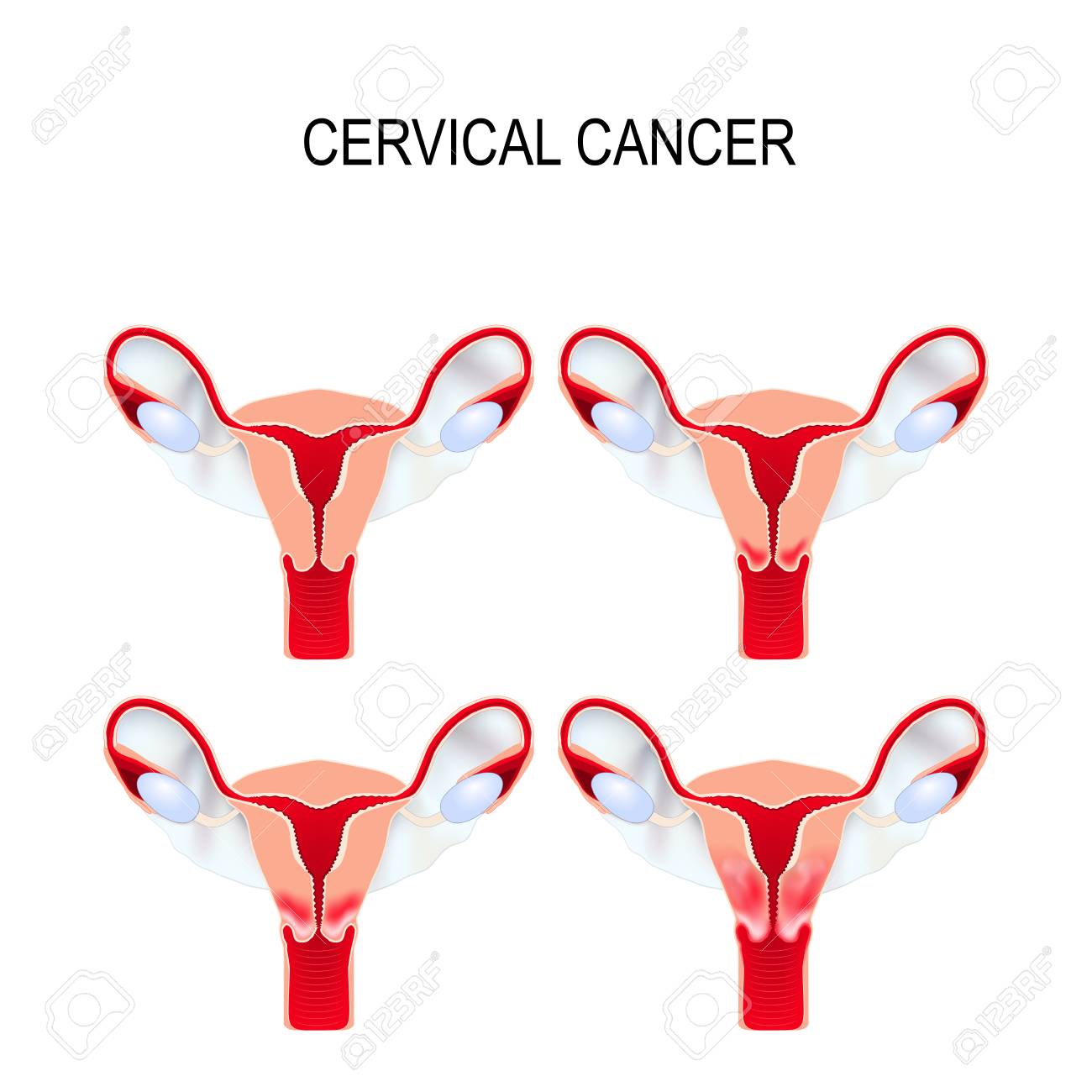 Cervical cancer staging. Carcinoma of Cervix. Malignant neoplasm arising from cells in the cervix uteri. - 89779598 Cervical cancer staging. Carcinoma of Cervix. Malignant neoplasm arising from cells in the cervix uteri. - 89779598