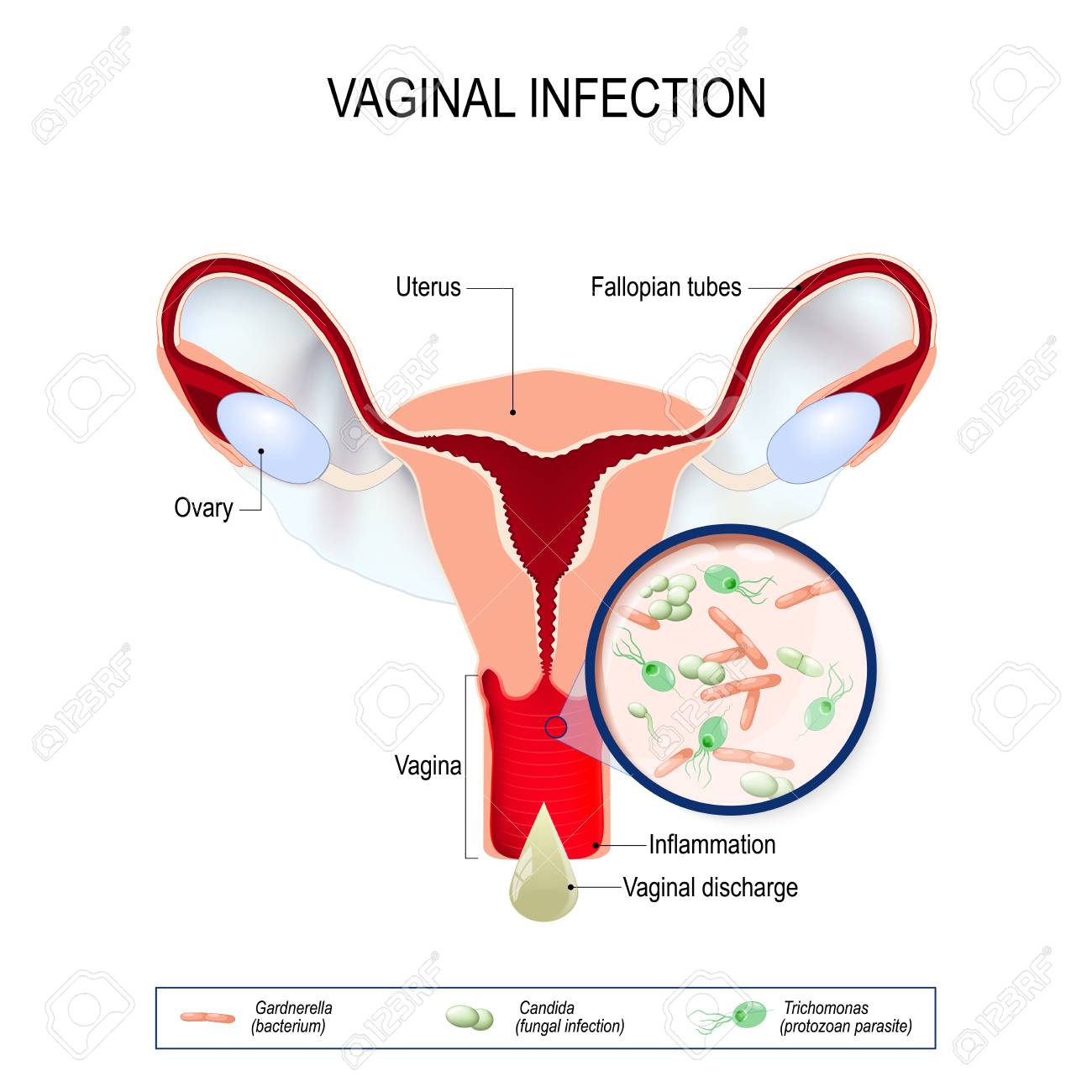 Trichomonas és gardnerellosis